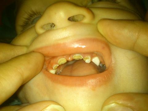 Zkařené zuby dvouletého syna