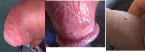Jedná se o HPV ? nebo jen papillaris genitalis ?