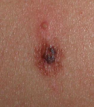 Rakovina kůže-melalom
