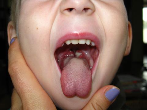 Opakované ORL nemoci bakteriálního původu u dítěte
