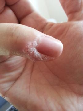 Tvrdá suchá kůže kolem nehtů