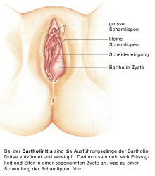 Bartolinitída