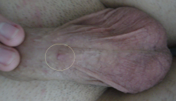 Vyrážka zo spodnej strany penisu