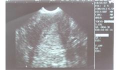 Ultrazvukové vyšetrenie gravidity