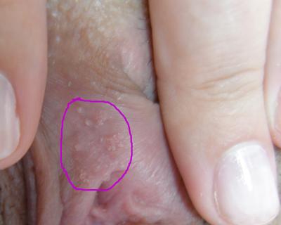 Vyrástky/vyrážky nad klitorisom