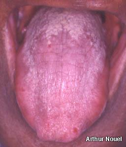 Syfilitická glossitis jazyka