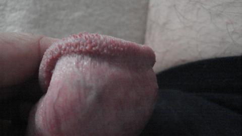 Hirsuties papillaris  nebo ne?