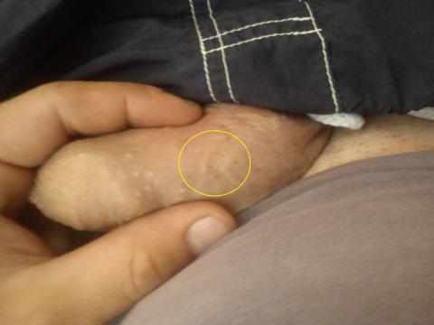 Kožny defekt na penise