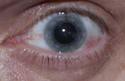 Červené žilky v oku
