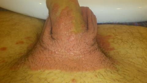Červená koža v okolí penisu