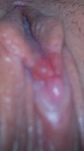 Začervenalý a bolestivý klitoris