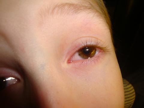 Pigmentace v oku u dítěte