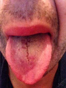 Cervene fliacky na jazyku