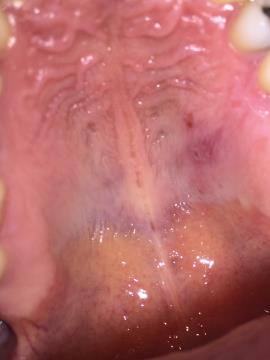 Syfilis v ústech