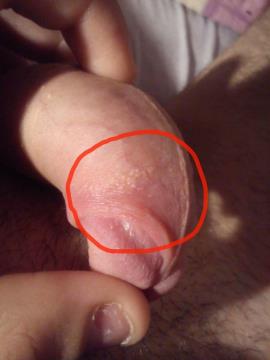 HPV?